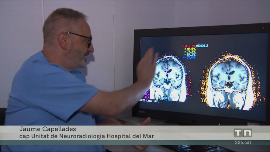 La Unitat de Neuroradiologia participa en la primera cirurgia làser a l’Estat en tractar un glioblastoma inoperable